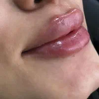 تزریق ژل و بوتاکس