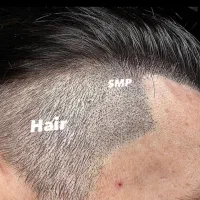 میکرو اسکالپ موی سر ،ریش، ابرو( در محل)|خدمات آرایشگری و زیبایی|تهران, سعادتآباد|دیوار