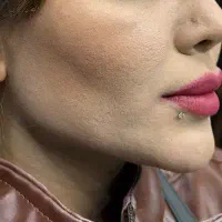 تزریق بایوفیلر پلاسماژل بیوفیلر