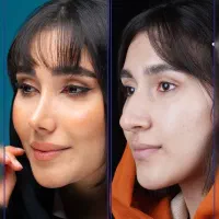 جراحی بینی با قیمت سال قبل +اقساط+مشاوره رایگان
