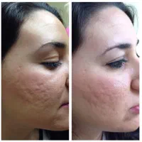 مزوتراپی ، PRP و مزونیدلینگ|خدمات آرایشگری و زیبایی|دوگنبدان, |دیوار