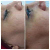 پاکسازی و فیشال تخصصی پوست