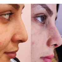 مژده همشهریان عزیزتخفیف 30 درصد خدمات جراحی ساکشن