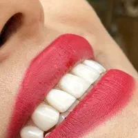 .تخفیف ویژه دندان پزشکی .کامپوزیت.وتمام خدامات|خدمات آرایشگری و زیبایی|اردبیل, |دیوار