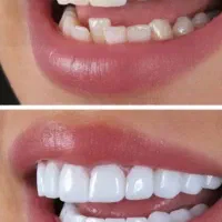 کامپوزیت دندان با متریال با کیفیت و قیمت مناسب