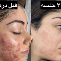 درمان جوش و لک و سیاهی زیرچشم