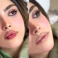 ژل لب/فیلر صورت/فیلر بادی/بوتاکس 50% تخفیف