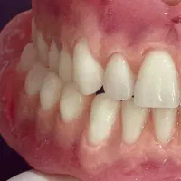 ساخت پروتز متحرک