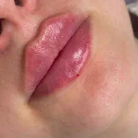 تزریقات زیبایی ،ژل بوتاکس،انواع مزوتراپی رفع غبغب