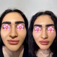 اموزش مجازی ژل و بوتاکس