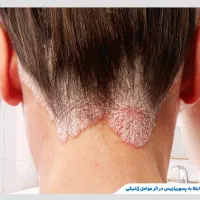 پیسی،پسوریازیس،کبد