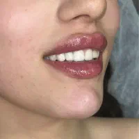 افر فیلر و بوتاکس،ژل ،مدل
