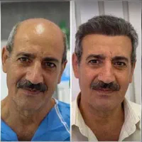 کاشت مو و ابرو و ریش بدون جراحی تراکم بالا|خدمات آرایشگری و زیبایی|تهران, الهیه|دیوار
