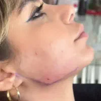 تزریق ژل بوتاکس و ساکشن تزریق چربی درکلینیک|خدمات آرایشگری و زیبایی|کرمانشاه, |دیوار