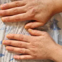 تزریق چربی ،تزریق ژل و بوتاکس