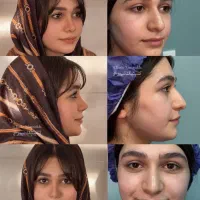 شرایط استثنایی عمل بینی
