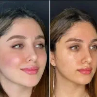 ساکشن و تزریق چربی تخصص ماست
