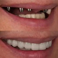 خدمات تخصصی ایمپلنت و اوردنچر دیجیتال|خدمات آرایشگری و زیبایی|کرج, جهان‌شهر|دیوار