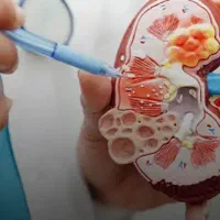 دختر سندروم نفروتیک ۱۰ ساله