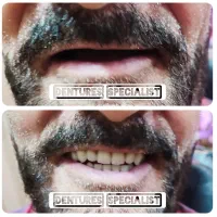 انواع‌ دندان متحرک حرفه ای طرح لمینیت و... باضمانت|خدمات آرایشگری و زیبایی|تهران, ائمه اطهار|دیوار
