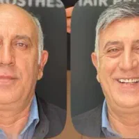 پروتز مو|خدمات آرایشگری و زیبایی|تهران, شهرک ولیعصر جنوبی|دیوار