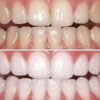 پودر سفید کننده دندان|آرایشی، بهداشتی، درمانی|اهواز, آریاشهر|دیوار