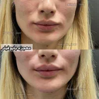 تزریق بایوفیلر کل صورت نچرال و طبیعی|خدمات آرایشگری و زیبایی|پاکدشت, پاکدشت (مامازند)|دیوار