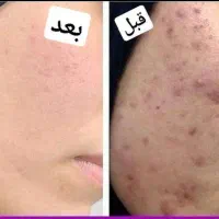 جشنواره پوست فیشال پاکسازی درمان لک جوش و جای جوش