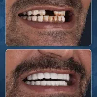 ایمپلنت دیجیتال بدون پیش پرداخت