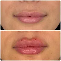 تزریق فیلر (ژل) بوتاکس مزو  در کلینیک ونوس با قی|خدمات آرایشگری و زیبایی|تهران, حر|دیوار