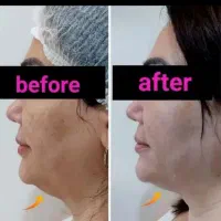 هایفوتراپی،رفع غبغب،لیزر،امبدینگ لاغری،prp|خدمات آرایشگری و زیبایی|سیرجان, |دیوار