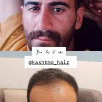 کاشت مو،ابرو،ریش وسیبیل،مزوتراپی وپی آرپی|خدمات آرایشگری و زیبایی|خرم‌آباد, |دیوار