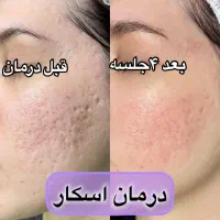 زیبایی صورتت با ما /مزونیدلینگ و PRP صورت