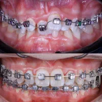 ارتودنسی فقط ۱۳ میلیون اقساط بدون چک.|خدمات زیبایی و سلامت|تهران, جردن|دیوار