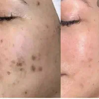 فیلر و بوتاکس به مدل نیازمندیم|خدمات آرایشگری و زیبایی|مشهد, سجادیه|دیوار