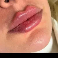 تزریق ژل و انواع مزو ژل های جوانساز