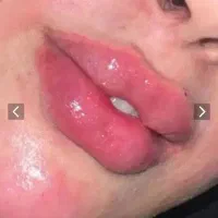 مدل برای تزریق بوتاکس،۹۵۰ژل۷۰۰،جوانساز زیرنظر پزشک