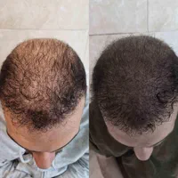 میکرو اسکالپ.اولین مرکز تخصصی میکرو اسکالپ در کرج|خدمات آرایشگری و زیبایی|کرج, عظیمیه|دیوار