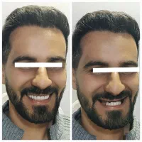 دست دندان متحرک کامل میخوای(کشیدنتون رایگان)|خدمات آرایشگری و زیبایی|شیراز, کاراندیش|دیوار