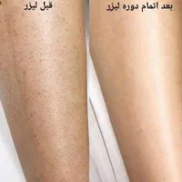 لیزرموهای زائد ویژه بانوان|خدمات آرایشگری و زیبایی|مشهد, توس (بلوار توس)|دیوار
