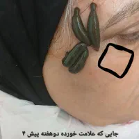 زالو درمانی و حجامت(فقط بانوان)