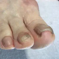 کفسابی پا.درمان ناخن پا.میخچه. ارتونیل ناخن پا