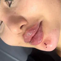 تزریق ژل لب گونه گونه زاویه فک و بوتاکس ۳۹۰