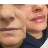 هایفو بوتاکس ژل لب زاویه سازی فیلر بادی هیپ سینه