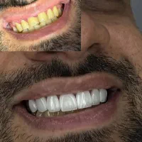 دندانپزشکی کامپوزیت دندان عصب کشی|خدمات آرایشگری و زیبایی|تهران, تهرانپارس غربی|دیوار