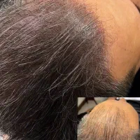 میکرو اسکالپ پوشش کم‌پشتی مو با رنگدانه|خدمات آرایشگری و زیبایی|تهران, حر|دیوار