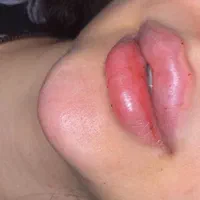 مرکز تخصصی ژل بوتاکس /کاشت امبدینگ لاغری در مطب