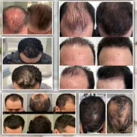 بیش از ۱۲ هزار نفر رویش مو داشتن