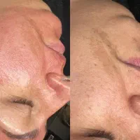 درمان کک و مک (خانم ها و اقایان)