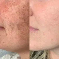 کرم روشن وضدلک قوی